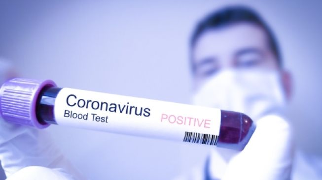 Ilustrasi tes darah untuk mengetahui pasien terinfeksi virus corona (coronavirus) atau tidak. (Shutterstock)